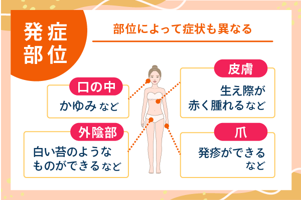発症部位 部位によって症状も異なる