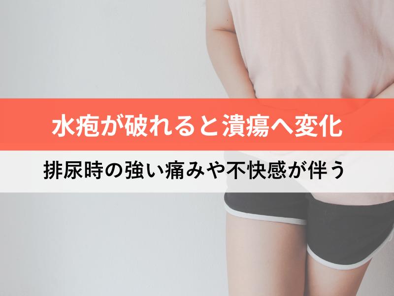 水疱が破れると潰瘍へ変化　排尿時の強い痛みや不快感が伴う