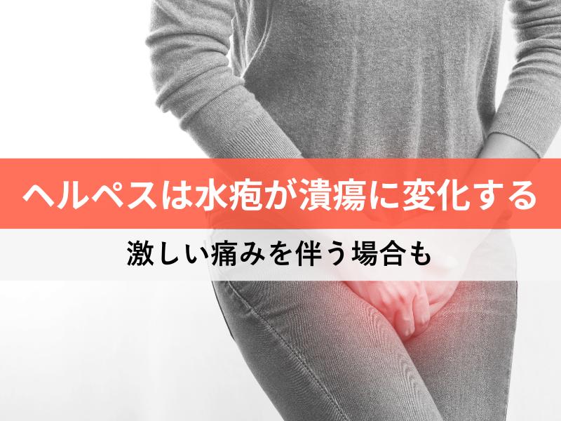 ヘルペスは水疱が潰瘍に変化する