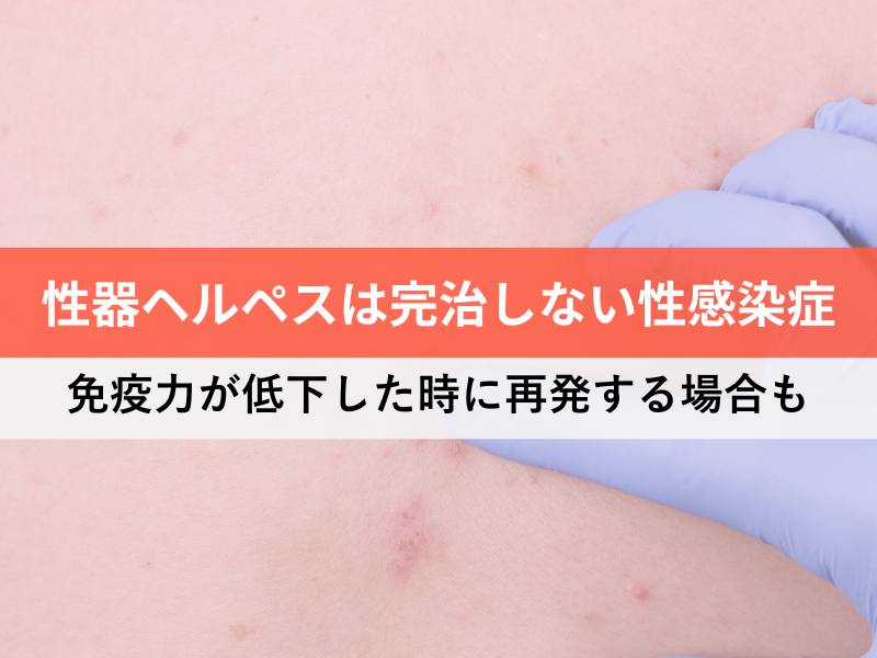 性器ヘルペスは完治しない性感染症 免疫力が低下したときに再発する場合も
